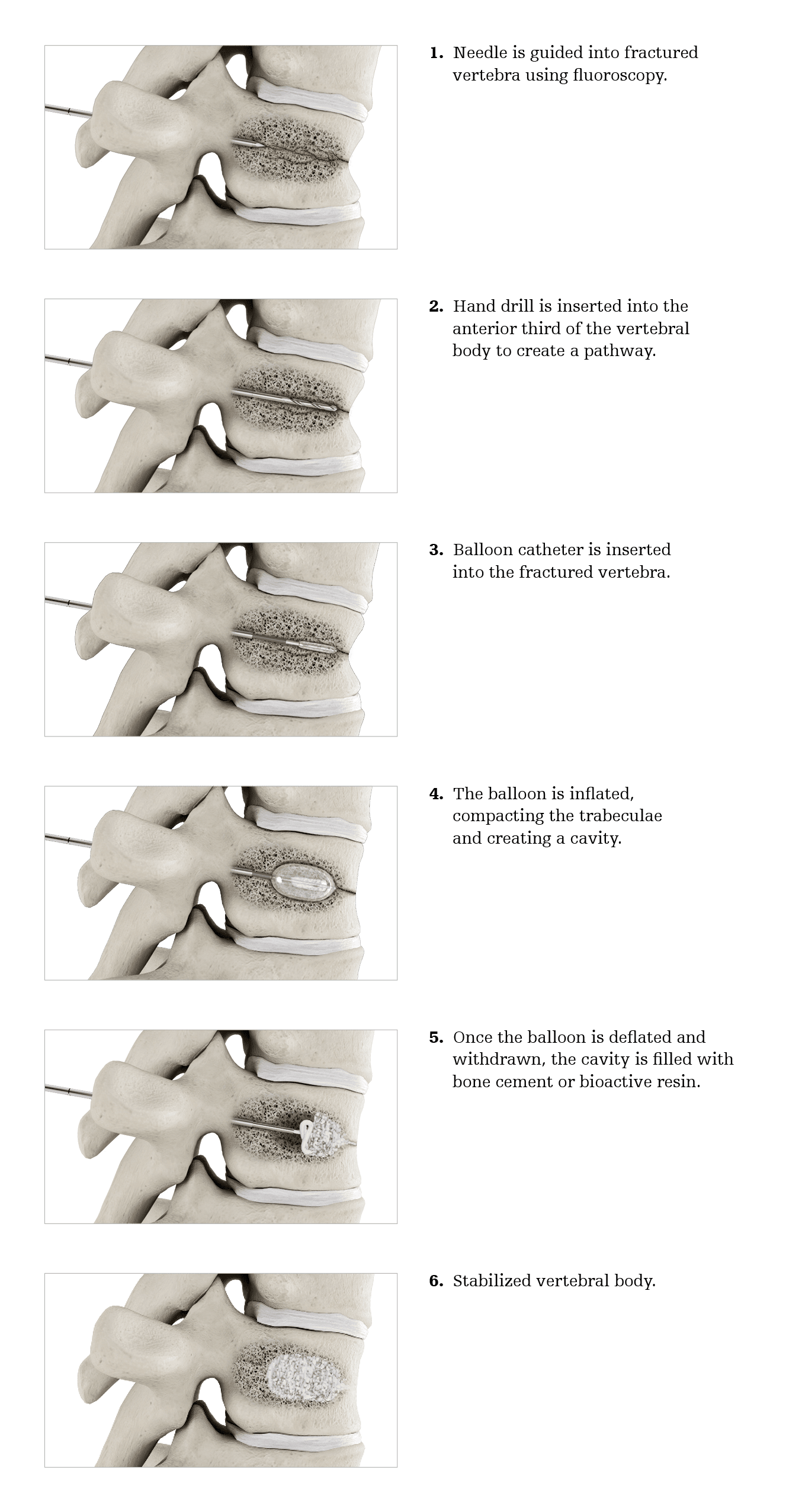 Balloon kyphoplasty: step-by-step procedure